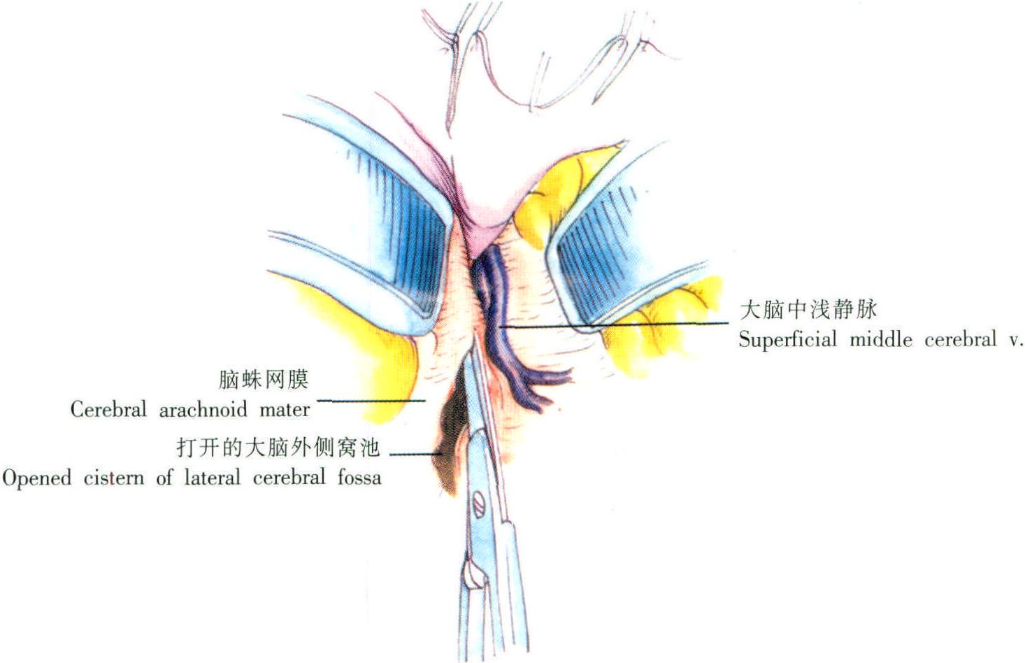 頸內(nèi)動(dòng)脈-后交通動(dòng)脈瘤夾閉術(shù) (一)